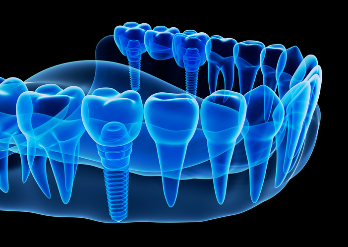 Rendering x-ray image of dental implant