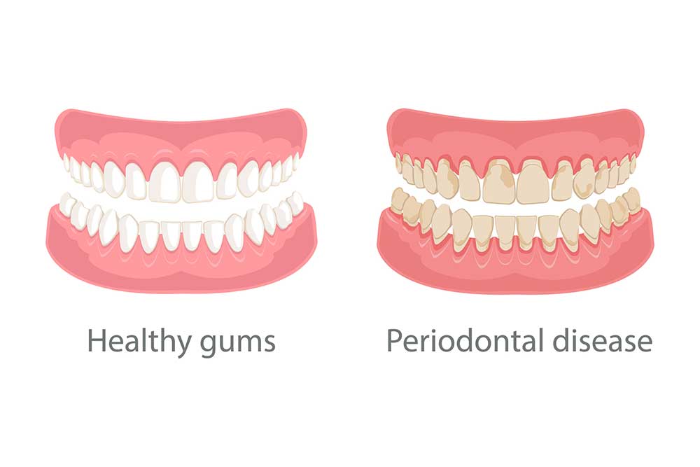 illustration of periodontal disease provided by Fairbanks Periodontal Associates in Fairbanks, AK