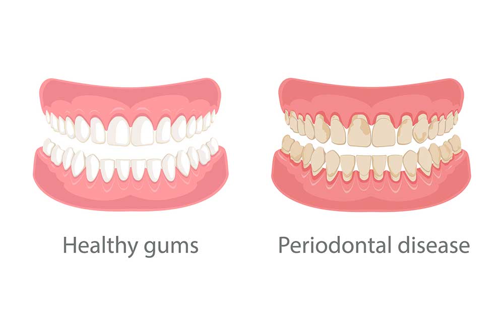 illustration of periodontal disease provided by Fairbanks Periodontal Associates in Fairbanks, AK illustration of periodontal disease provided by Fairbanks Periodontal Associates in Fairbanks, AK