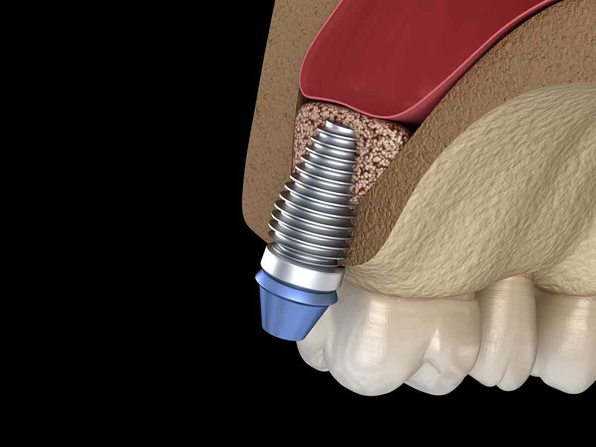 3D illustration of Sinus Lift Surgery from Fairbanks Periodontal Associates in Fairbanks, AK