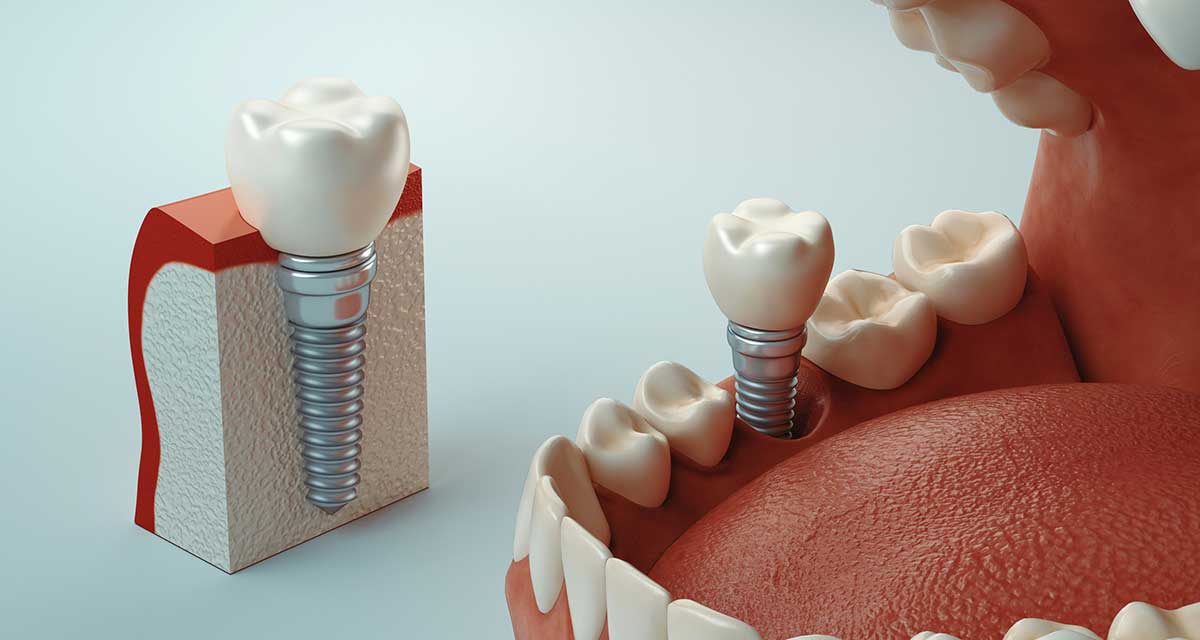 Model of tooth socket graft procedure from Fairbanks Periodontal Associates in Fairbanks, AK