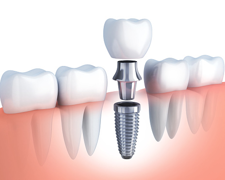Rendering image of a single tooth implant from Fairbanks Periodontal Associates in Fairbanks, AK Rendering image of a single tooth implant from Fairbanks Periodontal Associates in Fairbanks, AK