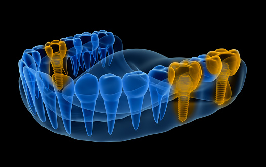 x-ray image of multiple dental implants from Fairbanks Periodontal Associates in Fairbanks, AK