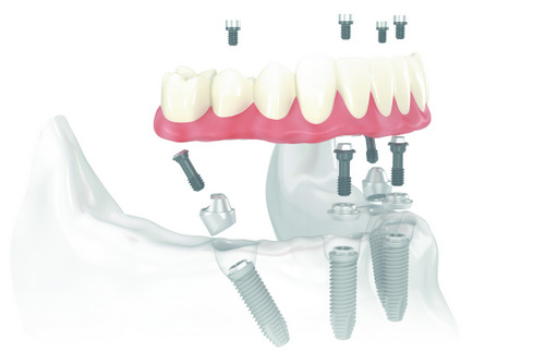 Render image of All-On-4 at Fairbanks Periodontal Associates in Fairbanks, AK