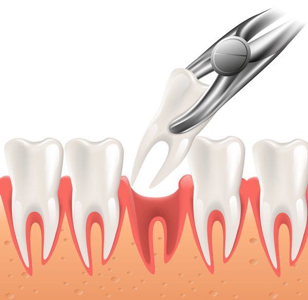 Rendered image of a tooth extraction from Fairbanks Periodontal Associates in Fairbanks, AK Rendered image of a tooth extraction from Fairbanks Periodontal Associates in Fairbanks, AK