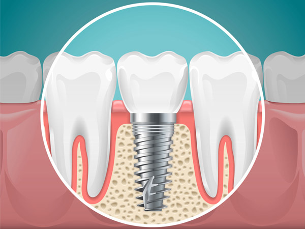 Diagram of a tooth replaced with a dental implant from Fairbanks Periodontal Associates, in Fairbanks, AK