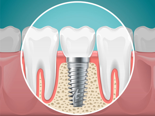 Diagram of a tooth replaced with a dental implant from Fairbanks Periodontal Associates, in Fairbanks, AK Diagram of a tooth replaced with a dental implant from Fairbanks Periodontal Associates, in Fairbanks, AK