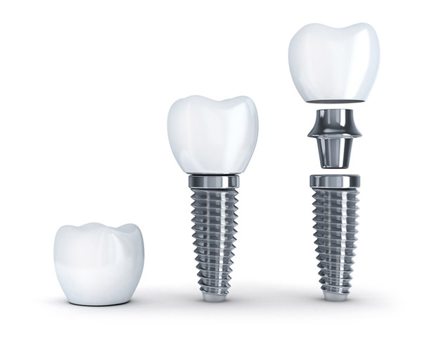 Diagram of single tooth implant with post at Fairbanks Periodontal Associates in Fairbanks, AK Diagram of single tooth implant with post at Fairbanks Periodontal Associates in Fairbanks, AK