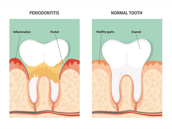 Diagram of periodontitis and healthy tooth from Fairbanks Periodontal Associates in Fairbanks, AK