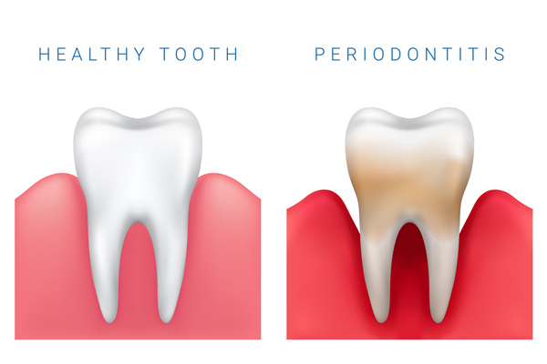 Comparison illustration of healthy tooth and periodontitis in Fairbanks