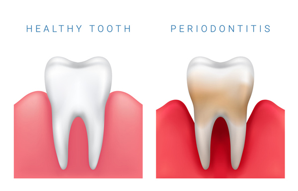 Diagram of healthy tooth compared to periodontitis diseased tooth at Fairbanks Periodontal Associates in Fairbanks, AK